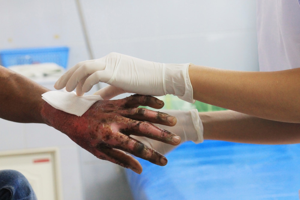 Dressing,Wound,Burn,Of,Second,Degree,Of,Wrist,And,Hand